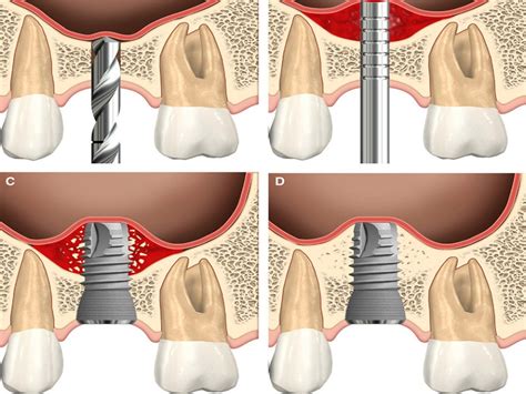  Jaw Bone Substitute：Revolutionizing Bone Regeneration and Implant Fixation